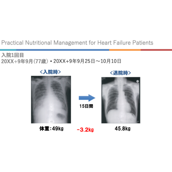 心不全3/4 | 心不全における栄養管理の実践 - 画像 (3)